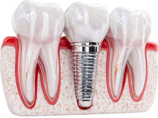 Advanced dental implants in Peth Vadgaon