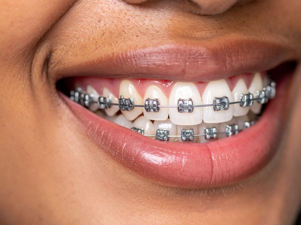 Orthodontic braces treatment in Peth Vadgaon