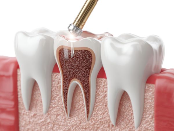 Painless root canal treatment in Peth Vadgaon
