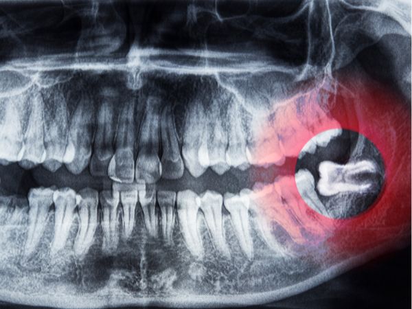 Wisdom tooth surgery in Peth Vadgaon